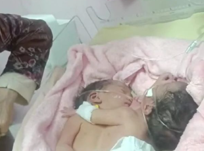 ولادة توأم سيامى "بقلب واحد" فى المغرب
