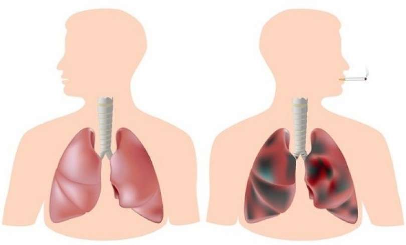 مشروب سحري لتنظيف الرئتين.. طوق نجاة للمدخنين